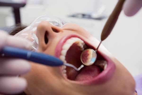 How Much Does A Tooth Filling Cost
