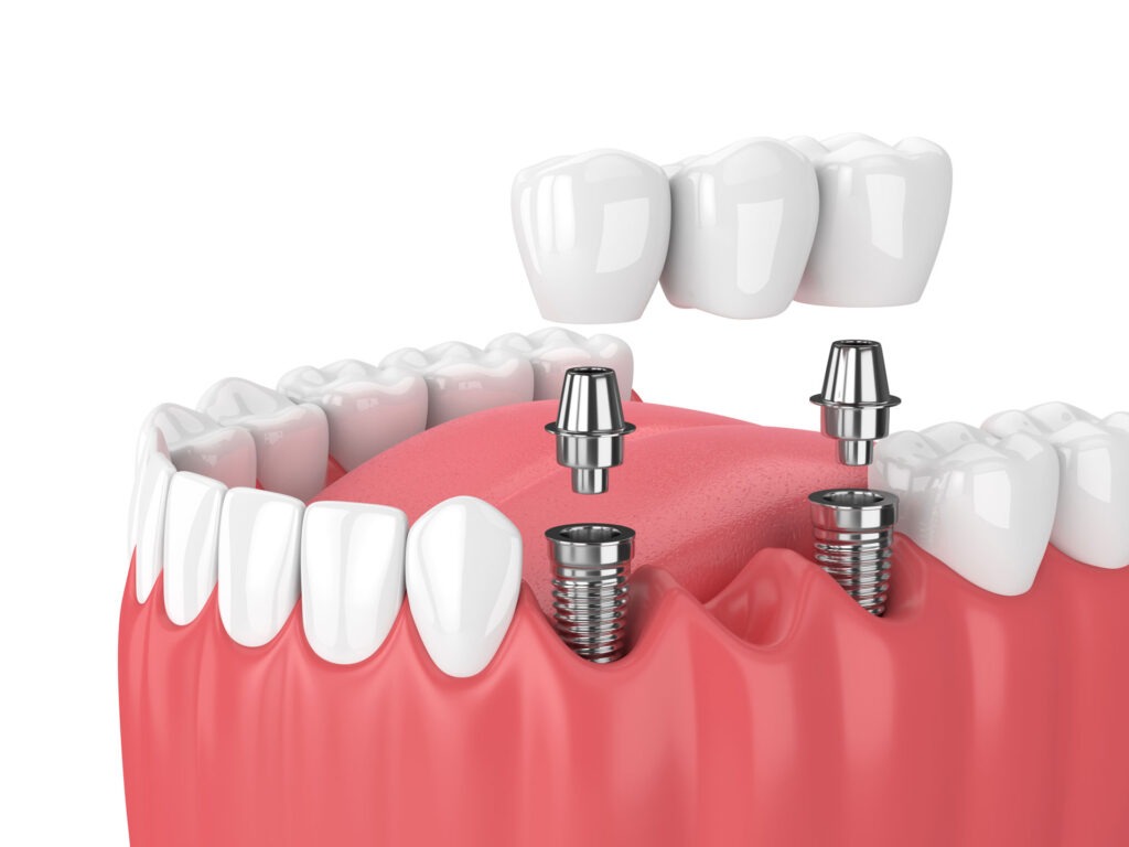 A dental implant-supported denture fitting in a patient's mouth