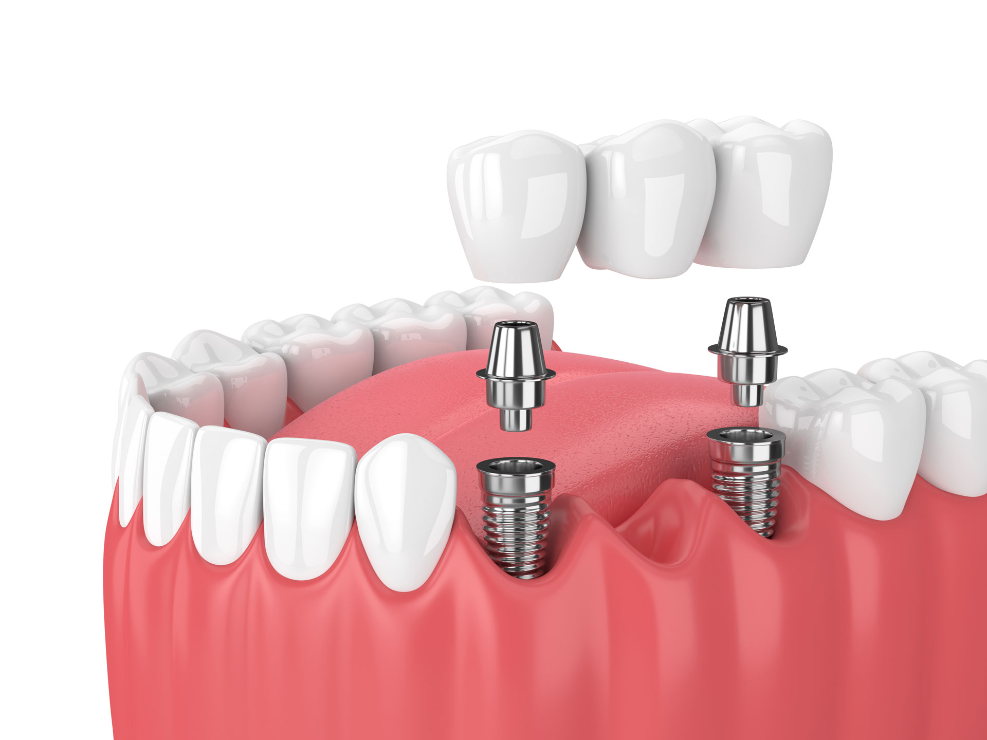 A dental implant-supported denture fitting in a patient's mouth