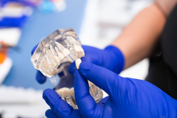 Have You Ever Wondered What Really Replaces a Missing Tooth